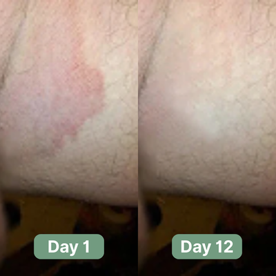 PURE™ Antifungal Soap®