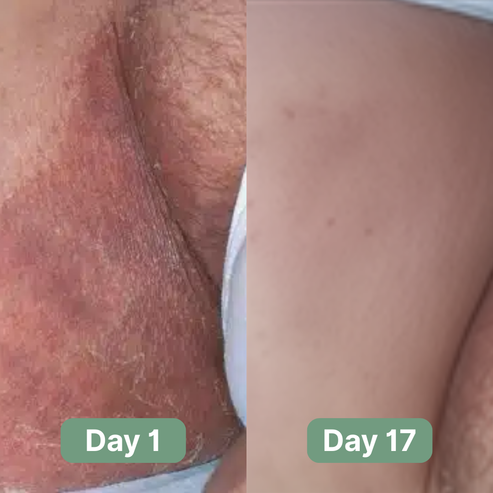 PURE™ Antifungal Soap®