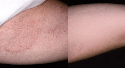 PURE™ Antifungal Soap®